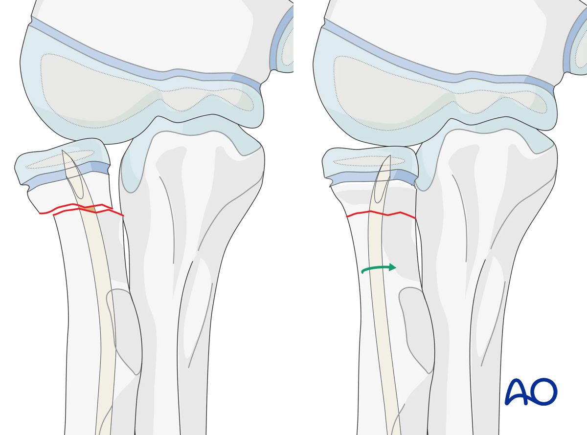 Reduction of the radial head during elastic nailing of a radial neck fracture in a pediatric patient