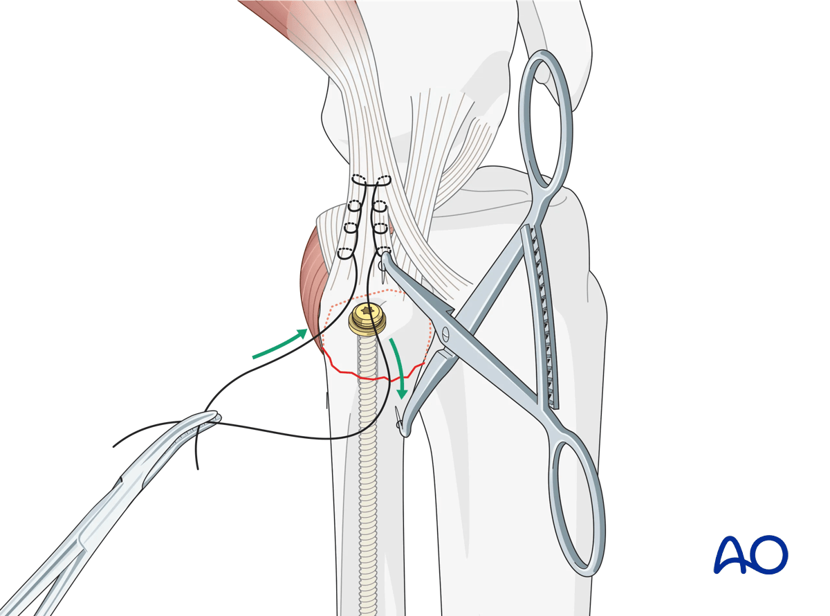Extraarticular avulsion of fibular head: fixation