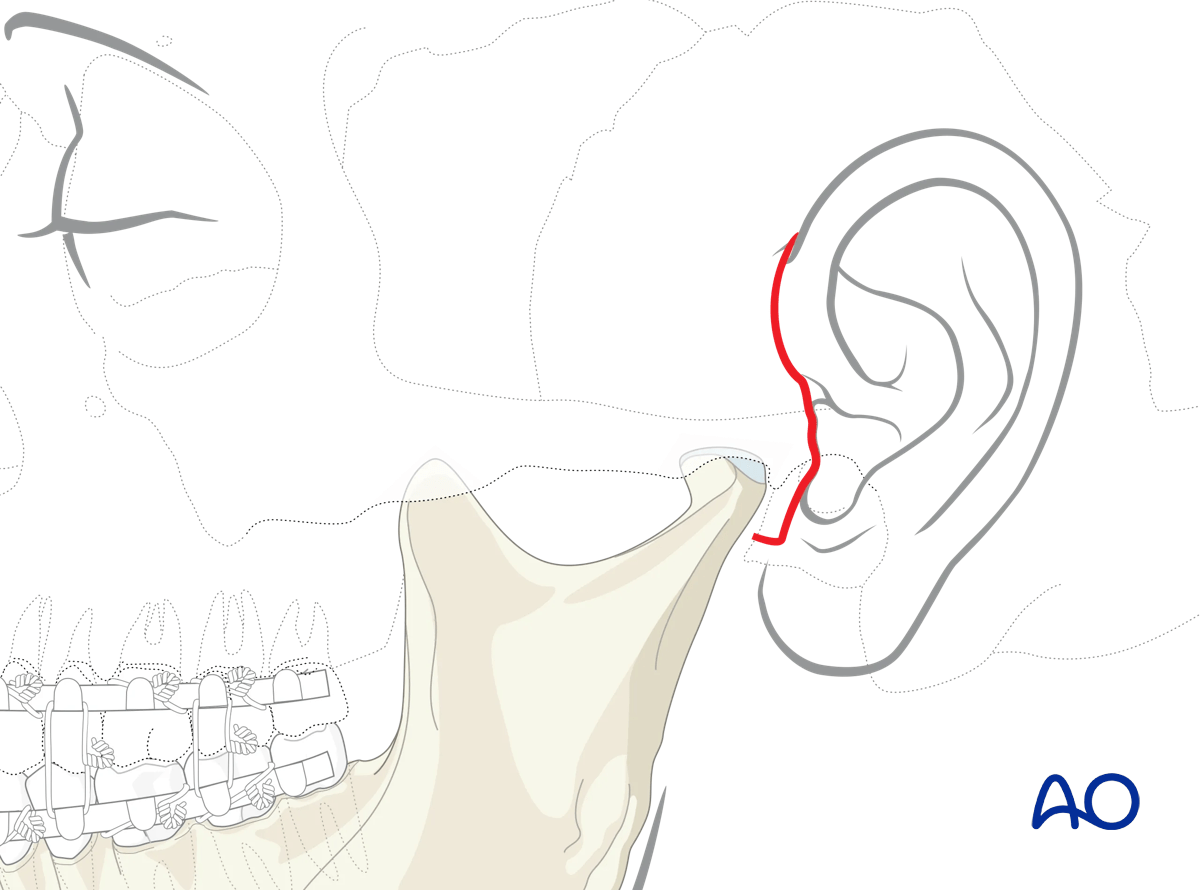 Endaural approach to condyle: Mark the incision in a preauricular skin crease at the superior part of the helix and extend caudally hugging the tragus to end just below the tragus.