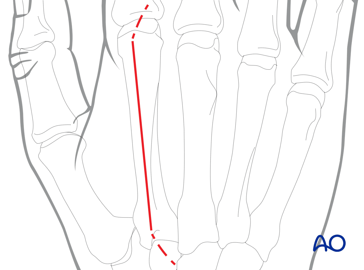 Dorsal approach to the metacarpals