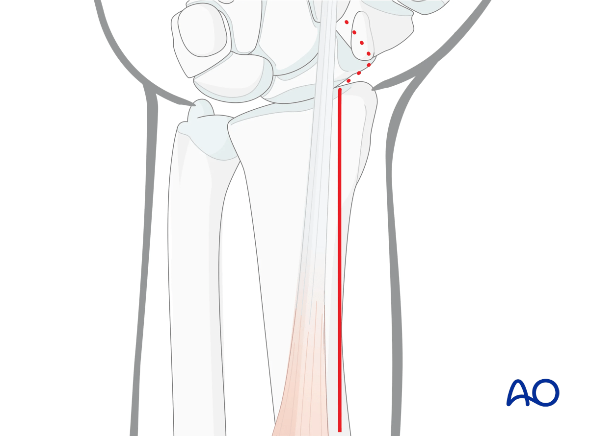 Palmar approach – modified Henry approach to the distal forearm