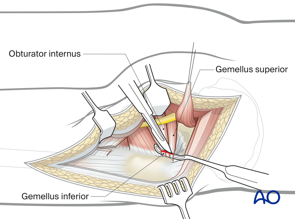Illustration of Kocher-Langenbeck approach: isolating conjoined tendon and reflecting muscle bellies.