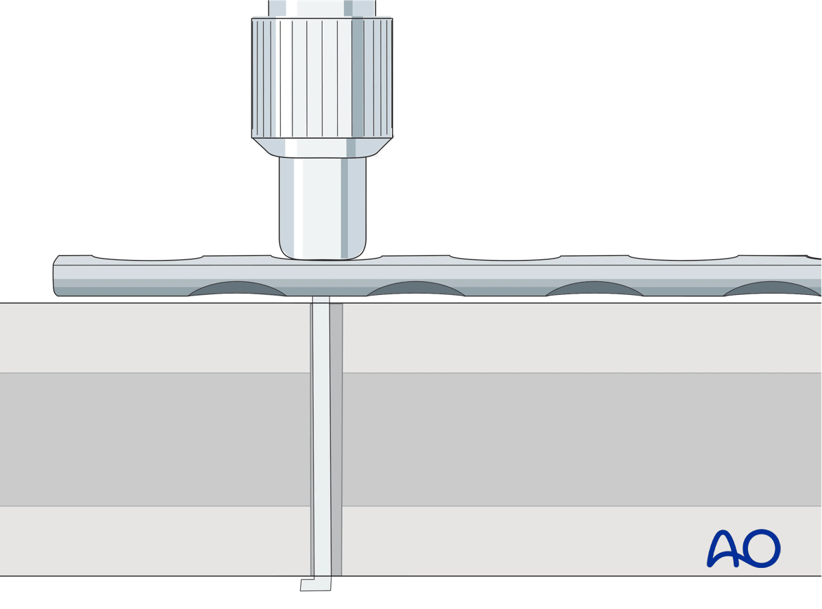 Determination of screw length