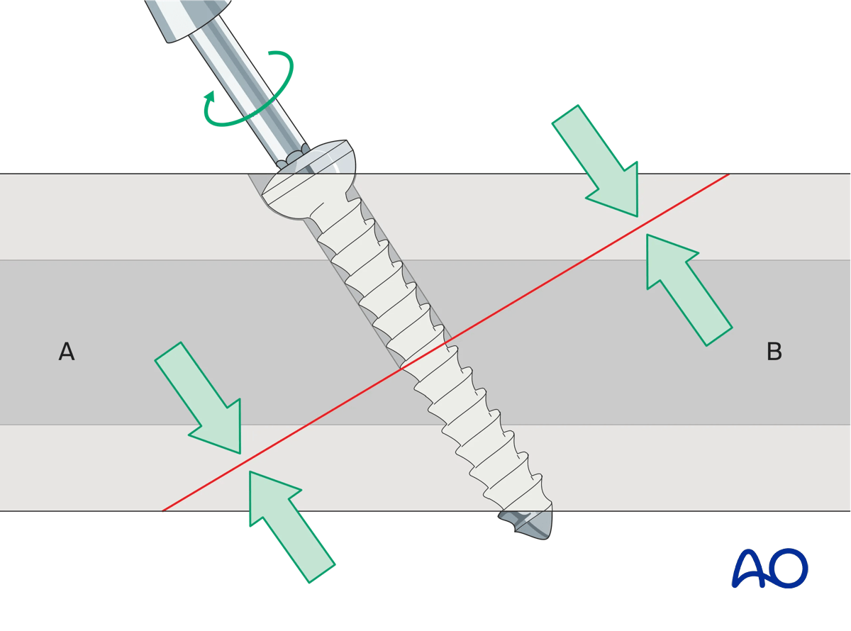 Lag screw compressing the fracture