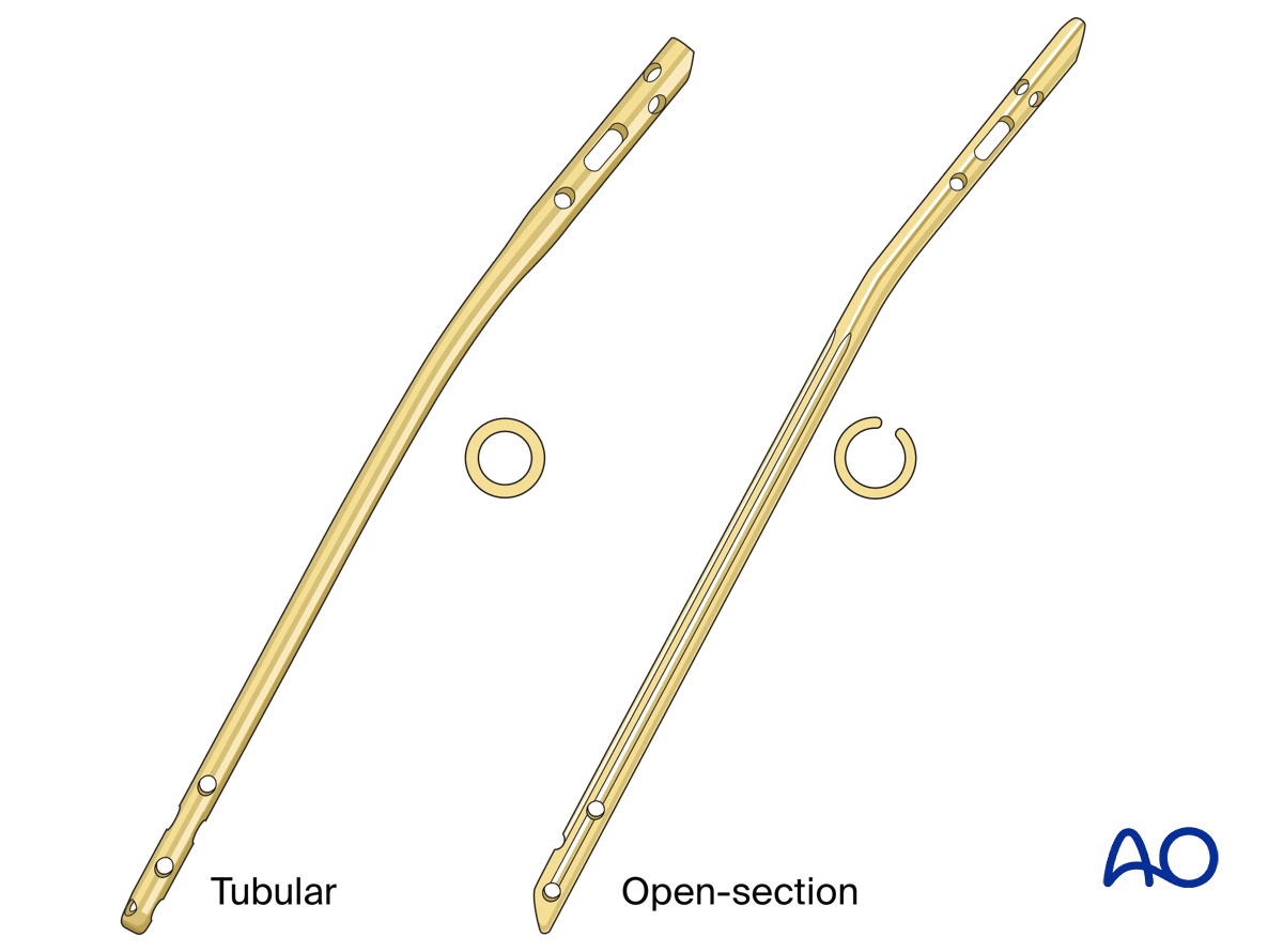 Suprapatellar intramedullary nailing, available tibial naisl