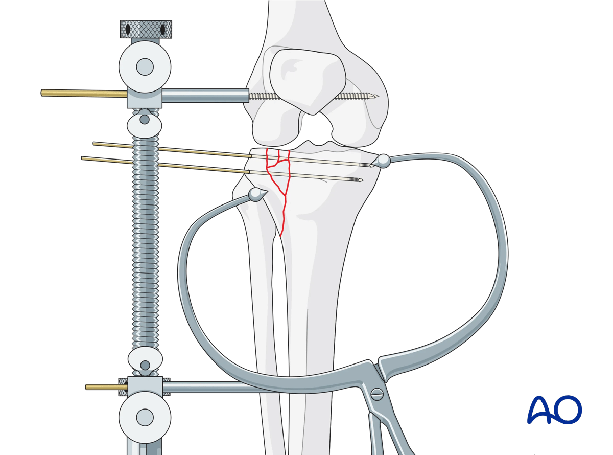 Proximal tibia Lateral plateau split-depression fracture – ORIF conventional plating – reduction of the lateral articular surface