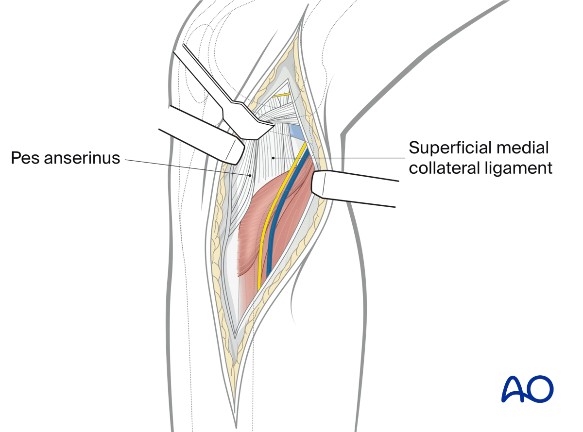 Medial/posteromedial approach to the proximal tibia, deep dissection