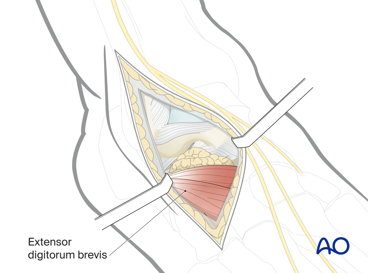 Extensor digitorum brevis one gains access to the lateral talus and subtalar joint anterolateral approach