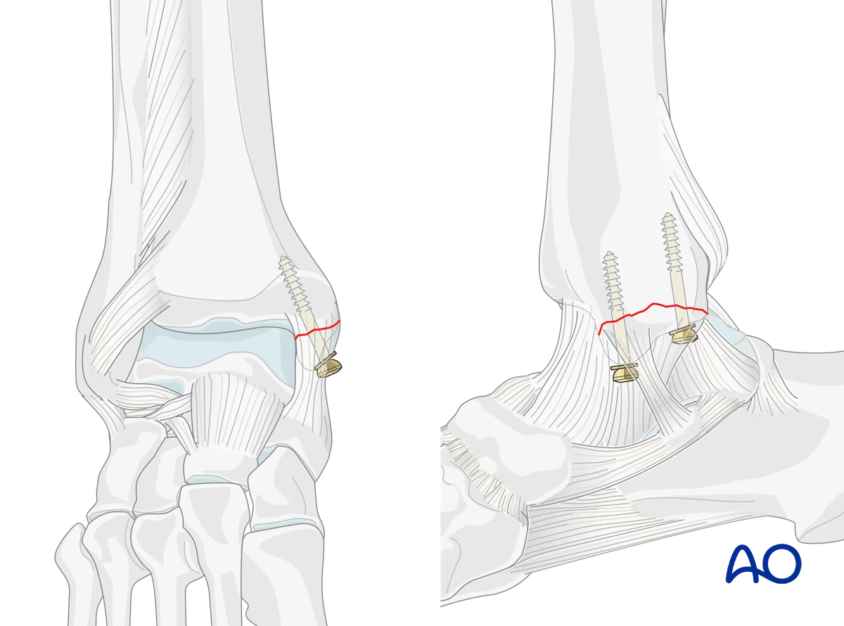 Screw fixation of a medial malleolar fracture