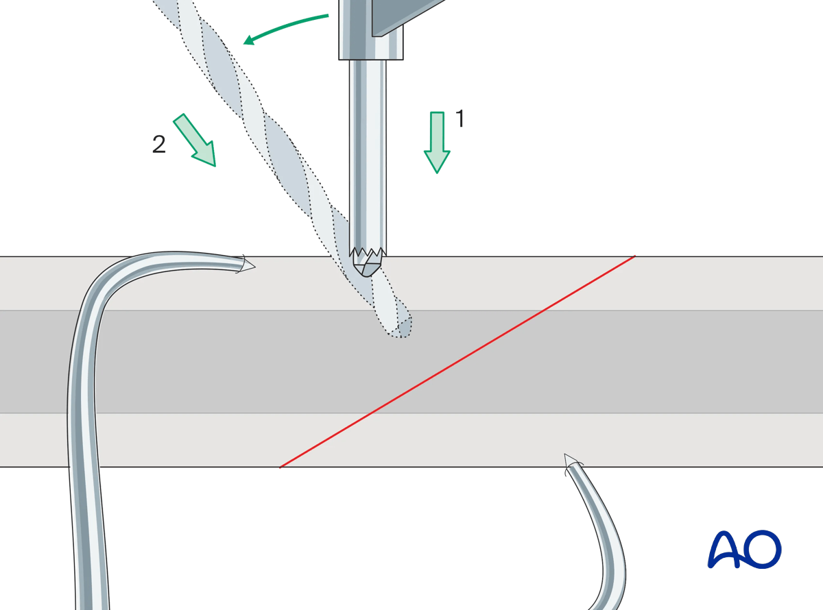 Pearl for drilling obliquely onto bone surface