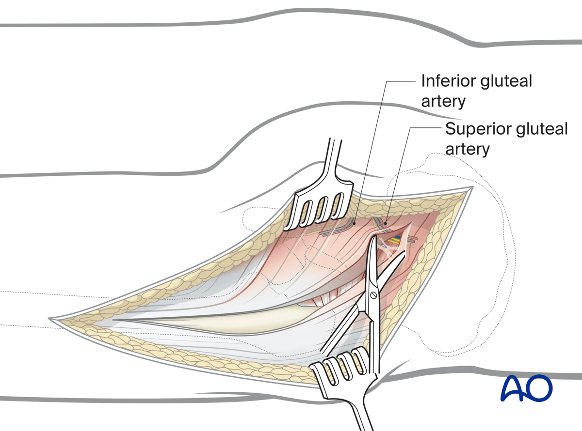 Illustration of Kocher-Langenbeck approach: splitting gluteus maximus and incising iliotibial tract.