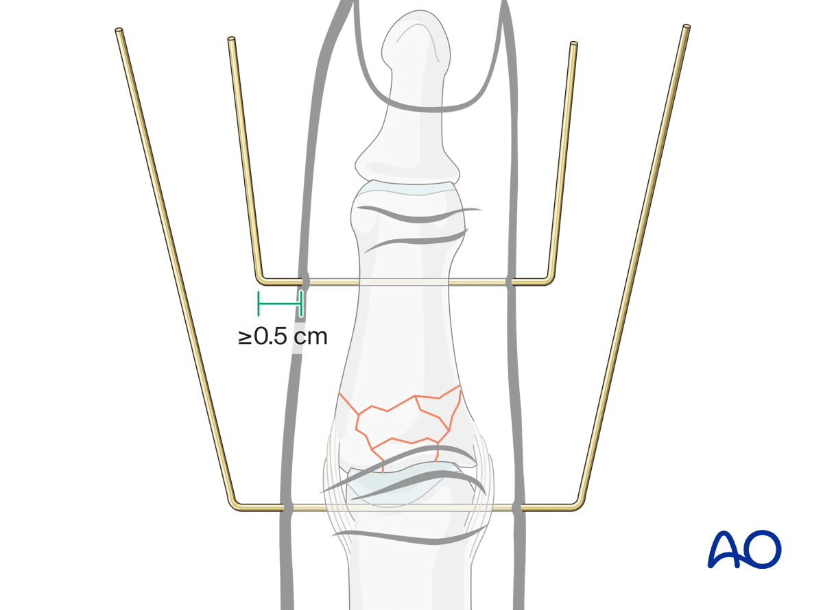 Dynamic external fixation: Bend both K-wires in a U-shape, leaving at least 0.5 cm between first bend and skin.