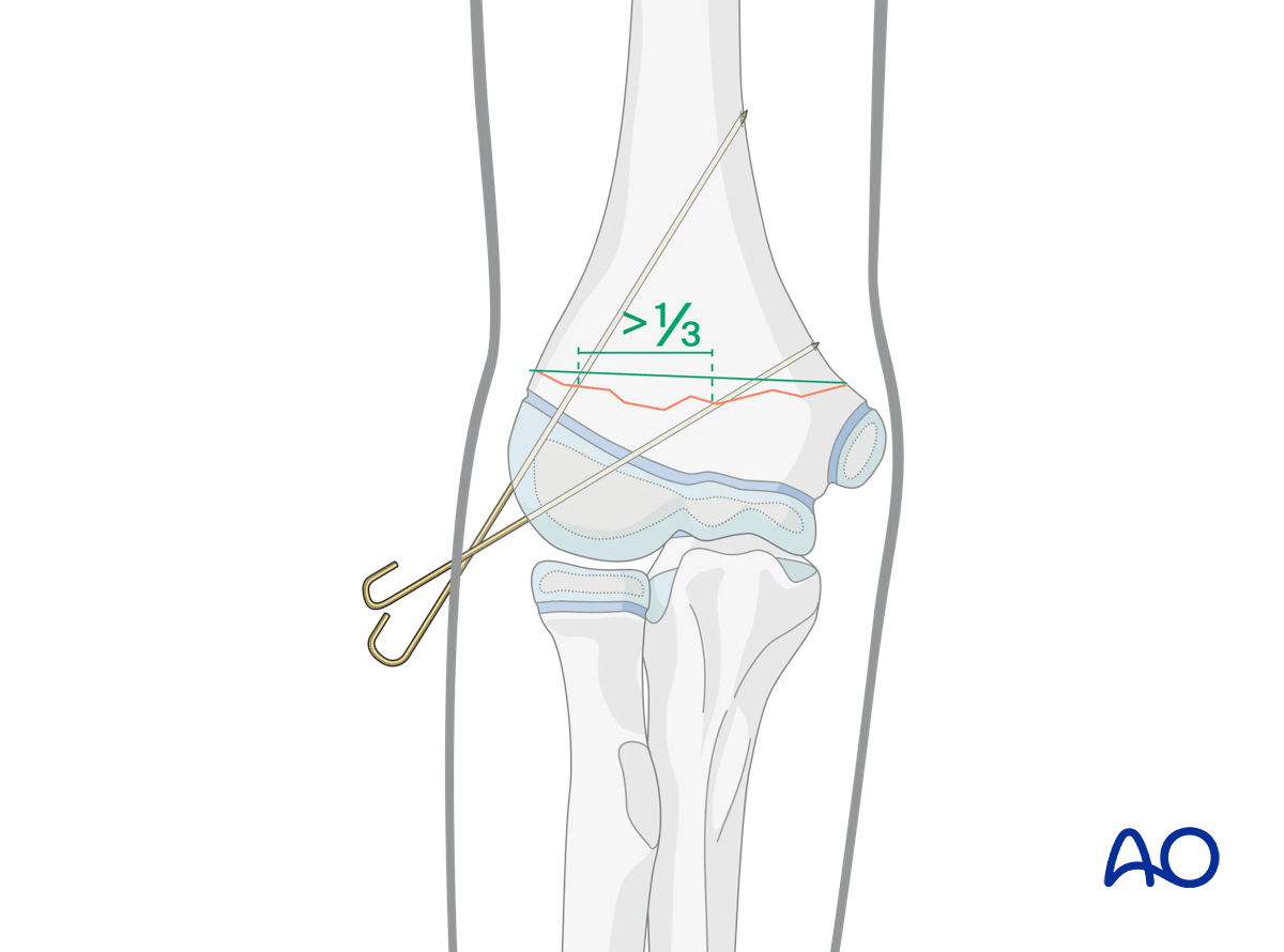 Monolateral divergent K-wires in a transverse supracondylar fracture