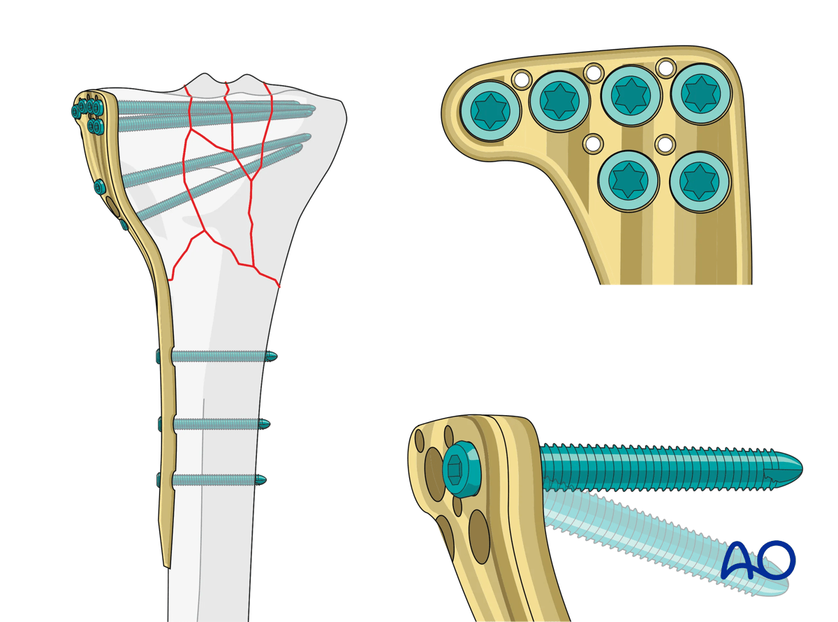 Proximal tibia: variable angle locking