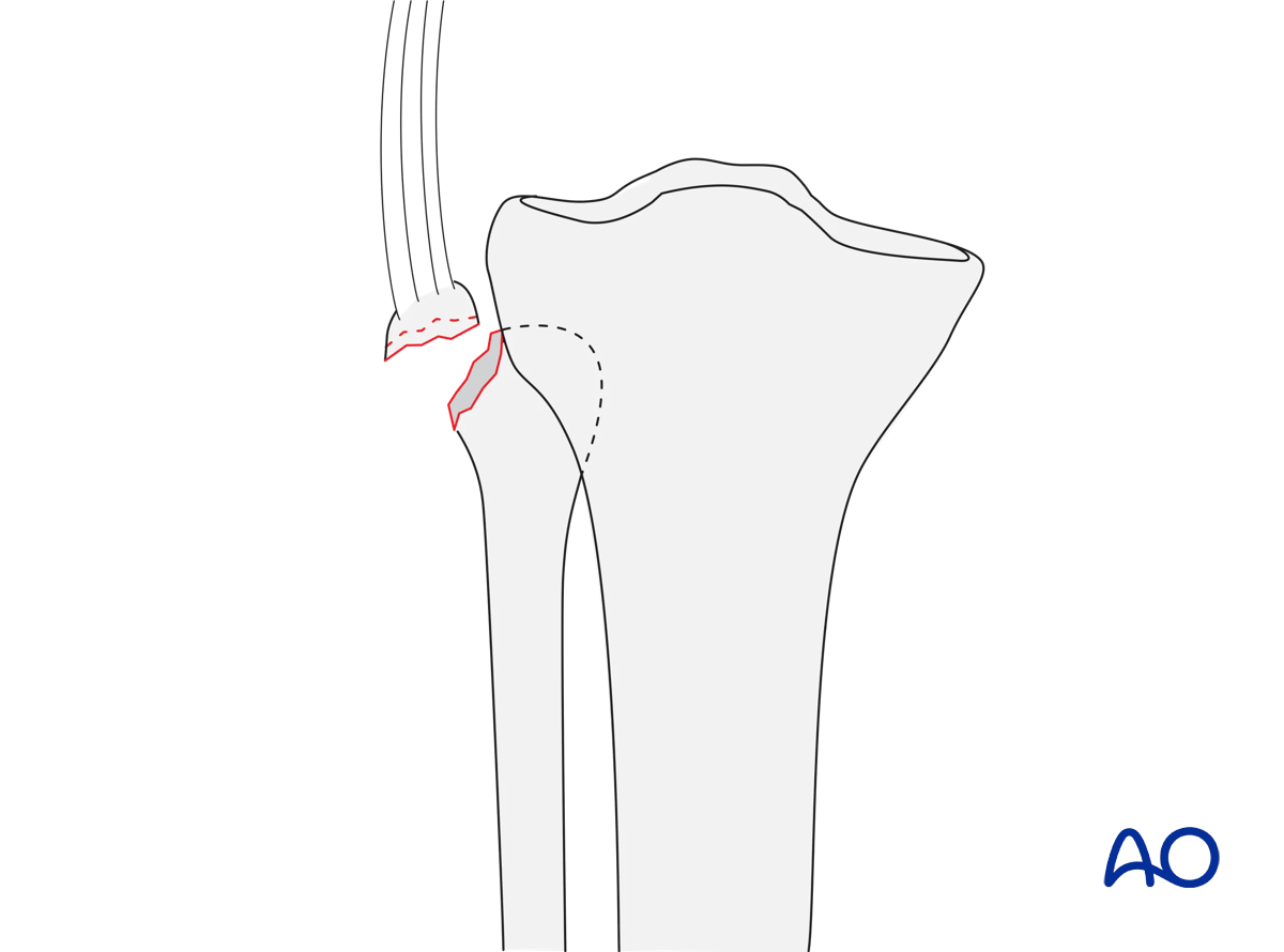 Fibular head