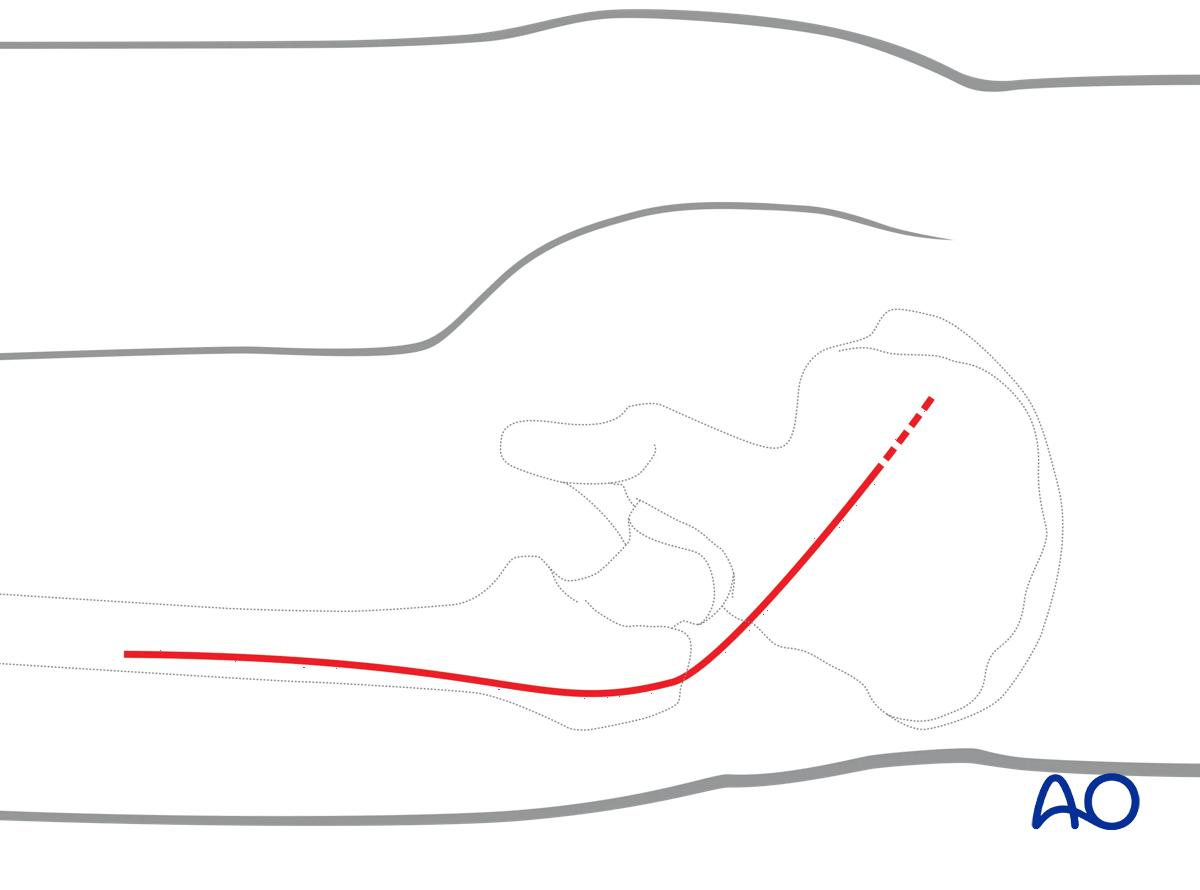 Kocher-Langenbeck approach for posterior acetabulum; visualize posterior column, retroacetabular surface; maintain knee flexion and hip extension to reduce sciatic nerve tension.
