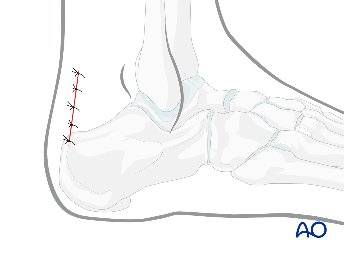 Posterolateral approach hindfoot approach is closed in layers