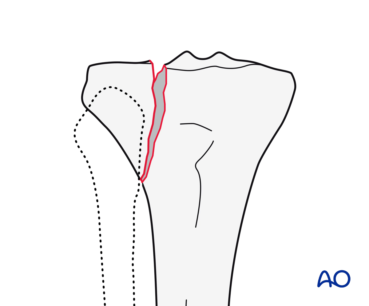 Proximal tibia: Lateral plateau split fracture
