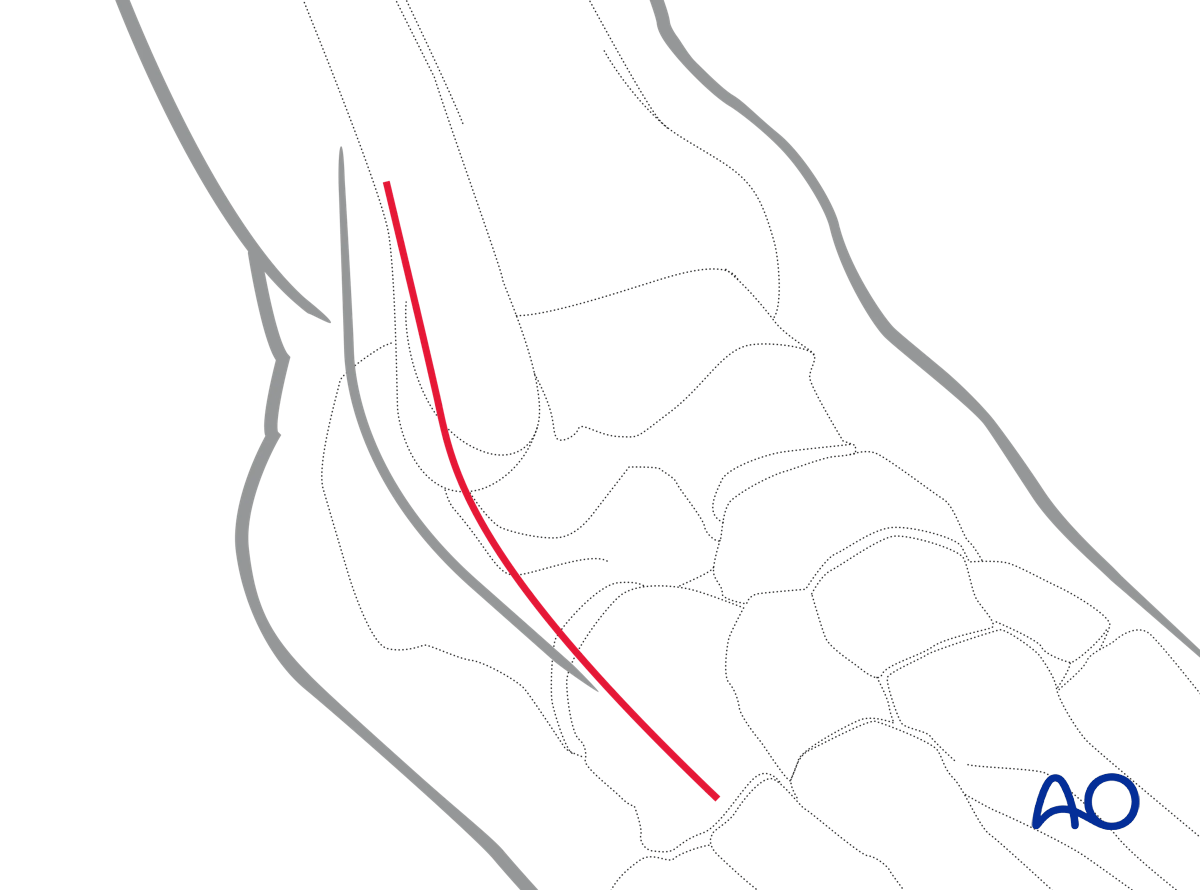 Anterolateral approach to expose talar neck fractures