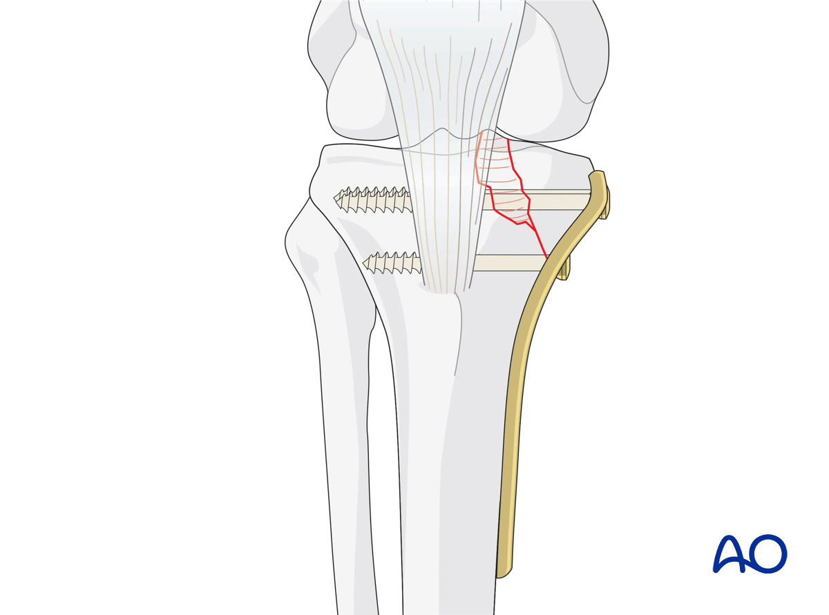 ORIF - Conventional plating, plate location