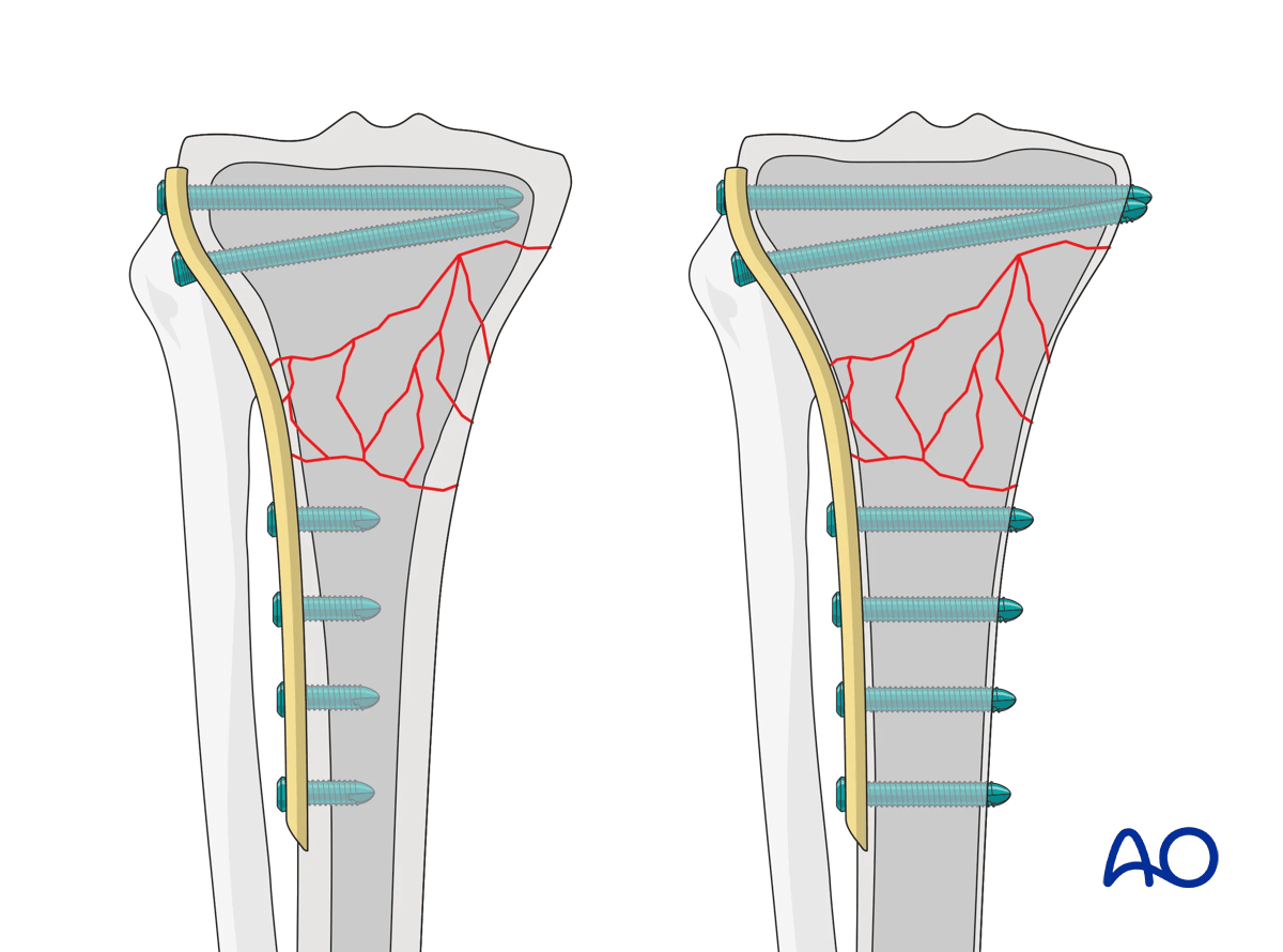 Proximal tibia: Wedge or multifragmentary extraarticular fracture Angular stable plating – preoperative planning