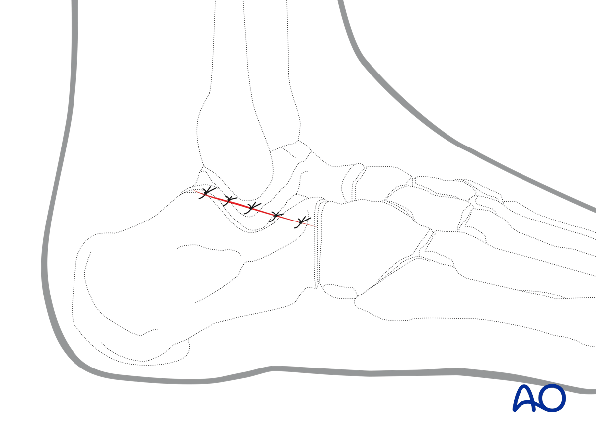 Sinus tarsi approach to the calcaneus wound closure with extensor digiti minimi replaced and sutured layers