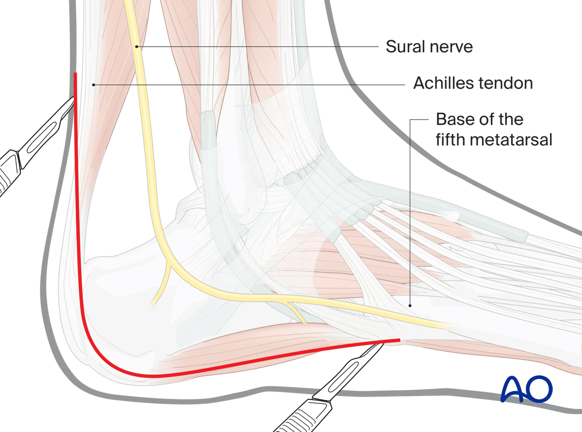 Extended lateral approach to the calcaneus: flap incision landmarks and direction to avoid sural nerve