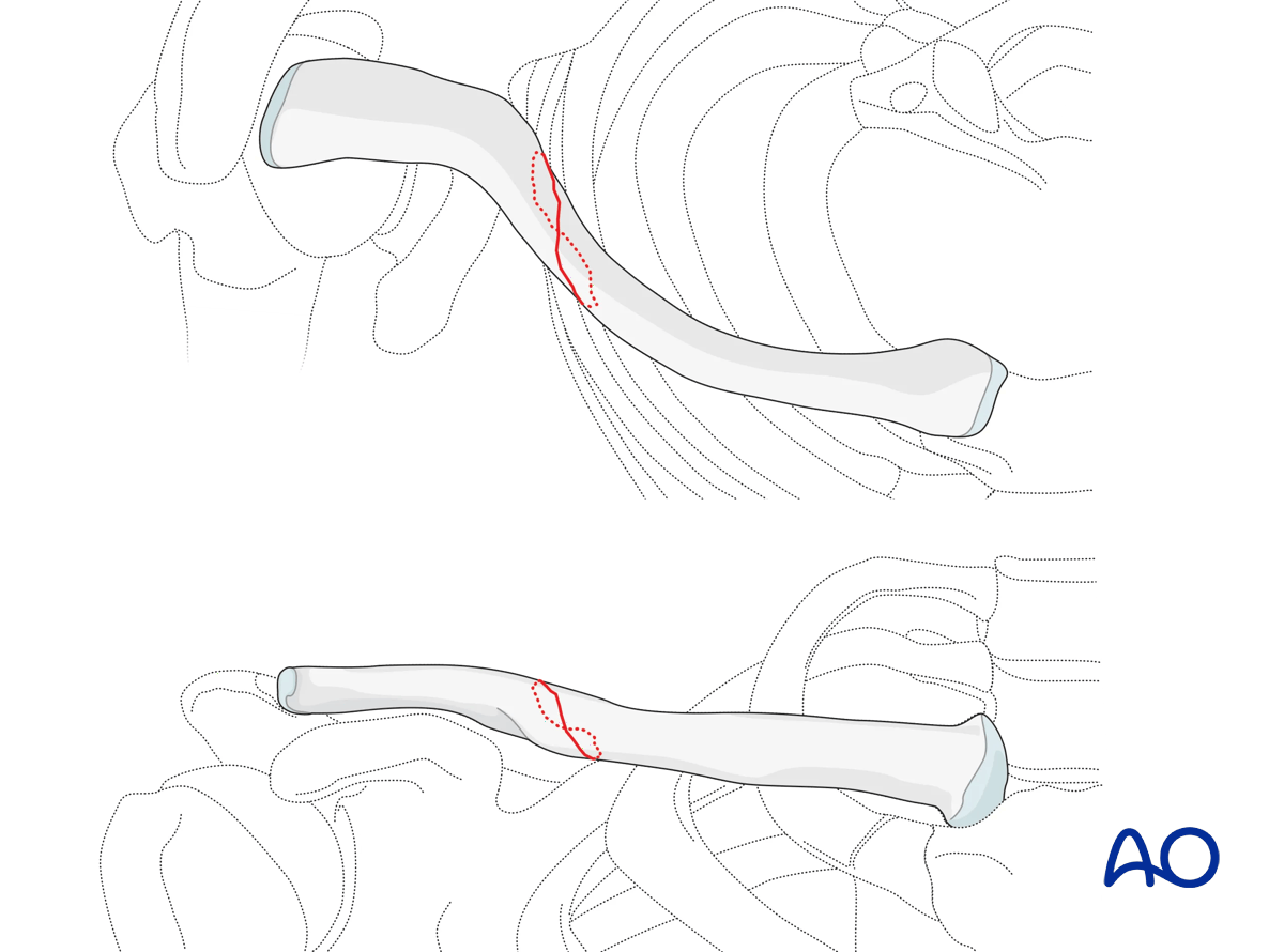 Clavicle: diaphyseal simple, spiral clavicle fracture