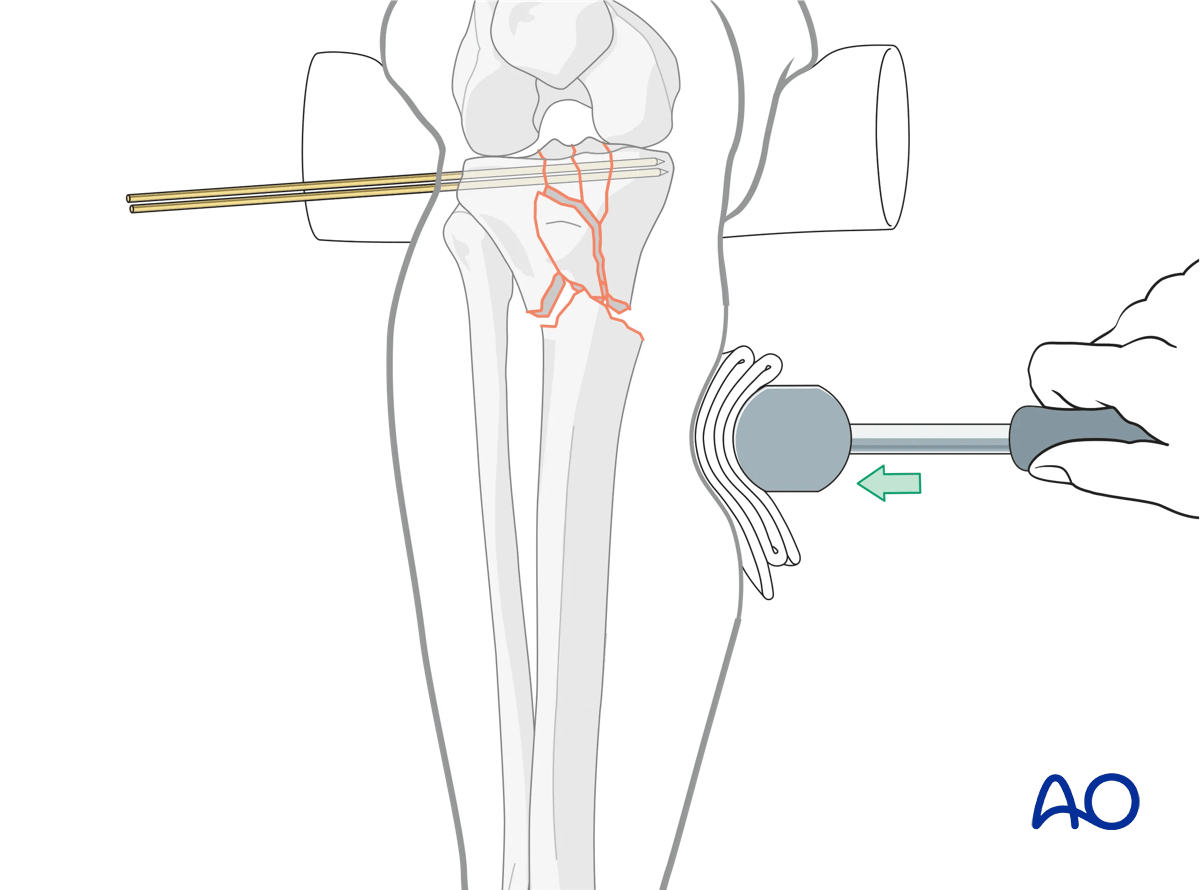 Proximal tibia: complete articular fracture - Angular stable plating – indirect reduction