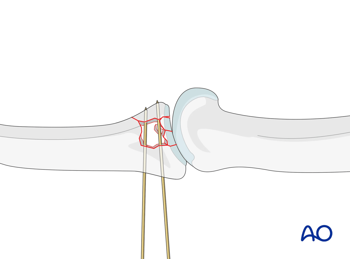 Dynamic external fixation: Insert K-wires from dorsal to palmar to stabilize articular fragments until fracture consolidation.