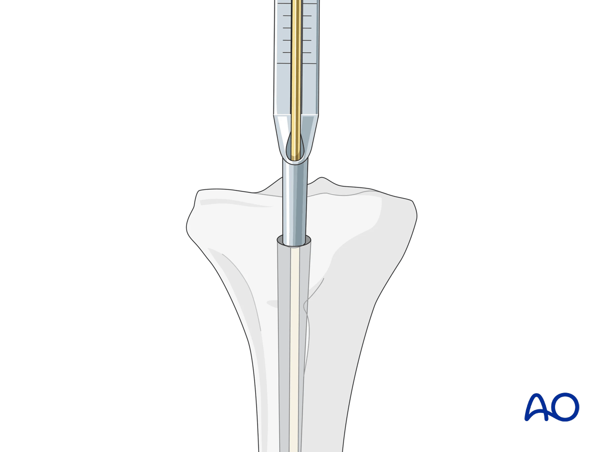 Tibia intramedullary nailing - determination of length using a depth gauge