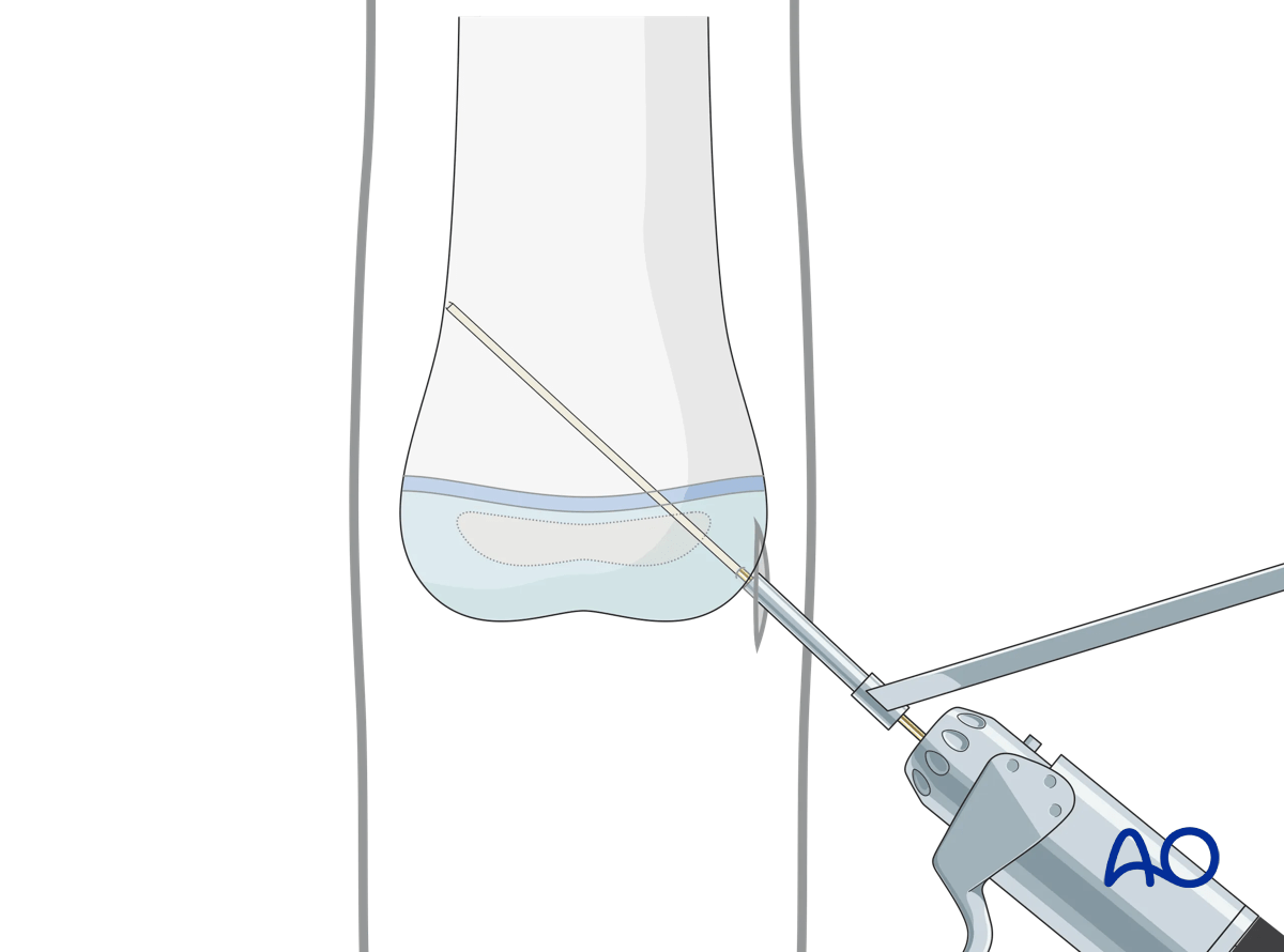 Use of a drill sleeve