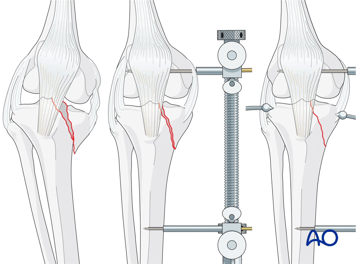 ORIF - Conventional plating, preliminary reduction