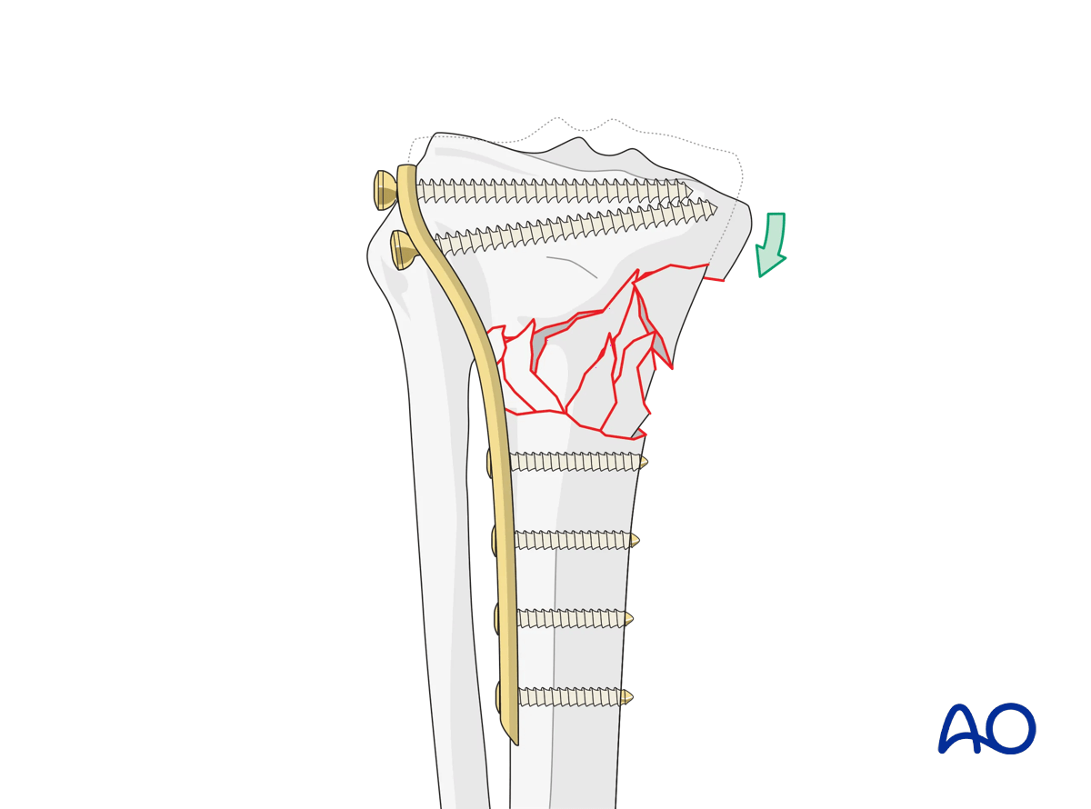 Proximal tibia: Wedge or multifragmentary extraarticular fracture Angular stable plating – principles