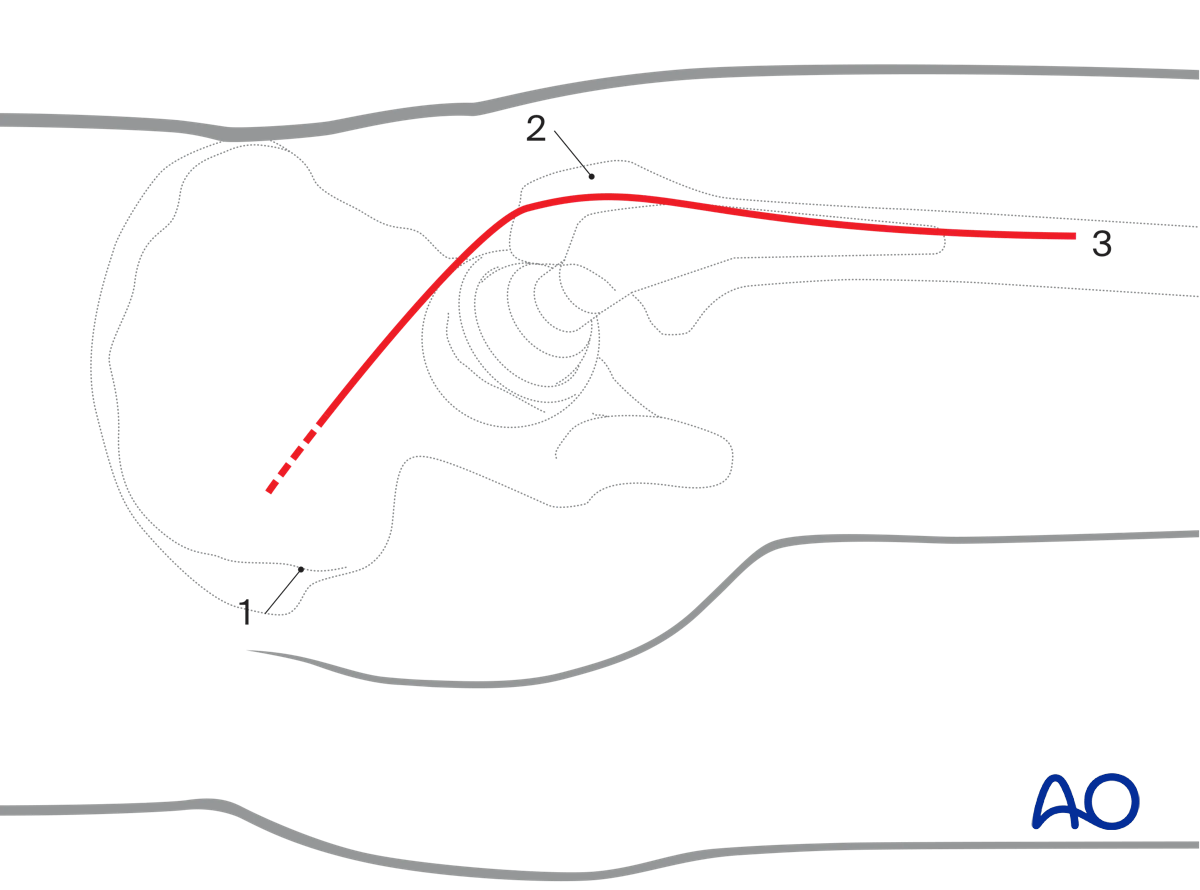 Skin incision landmarks for Kocher-Langenbeck approach to the hip