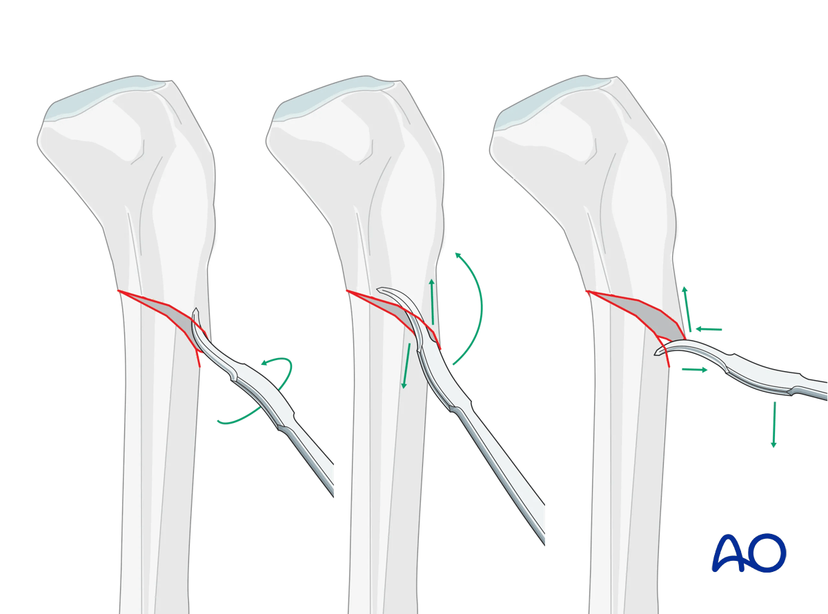 Suprapatellar intramedullary nailing, reduction of transverse fractures