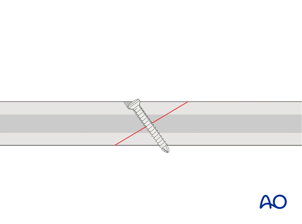Lag screw fixation of an oblique diaphyseal fracture