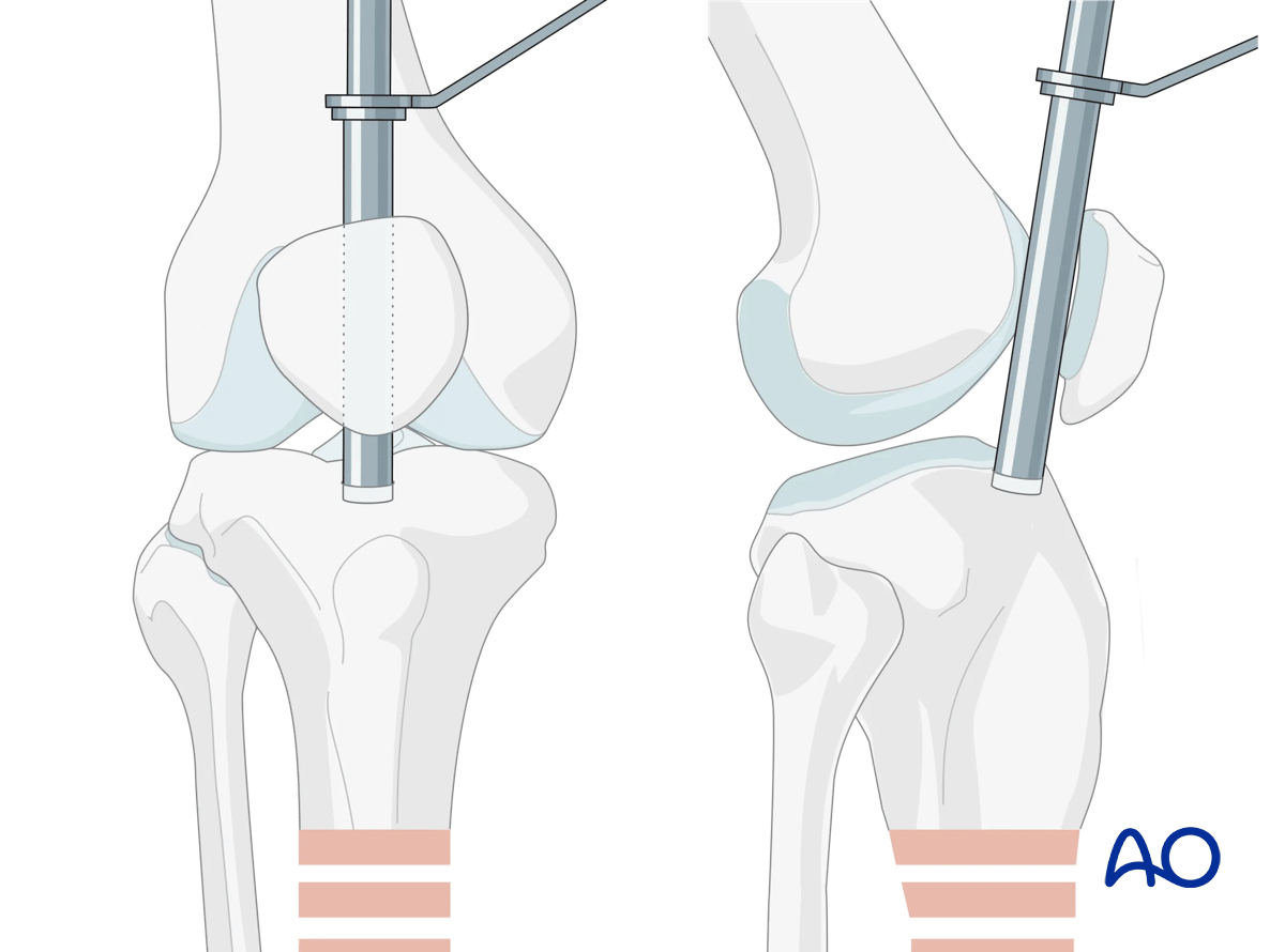 Suprapatellar intramedullary nailing, tools for opening the bone