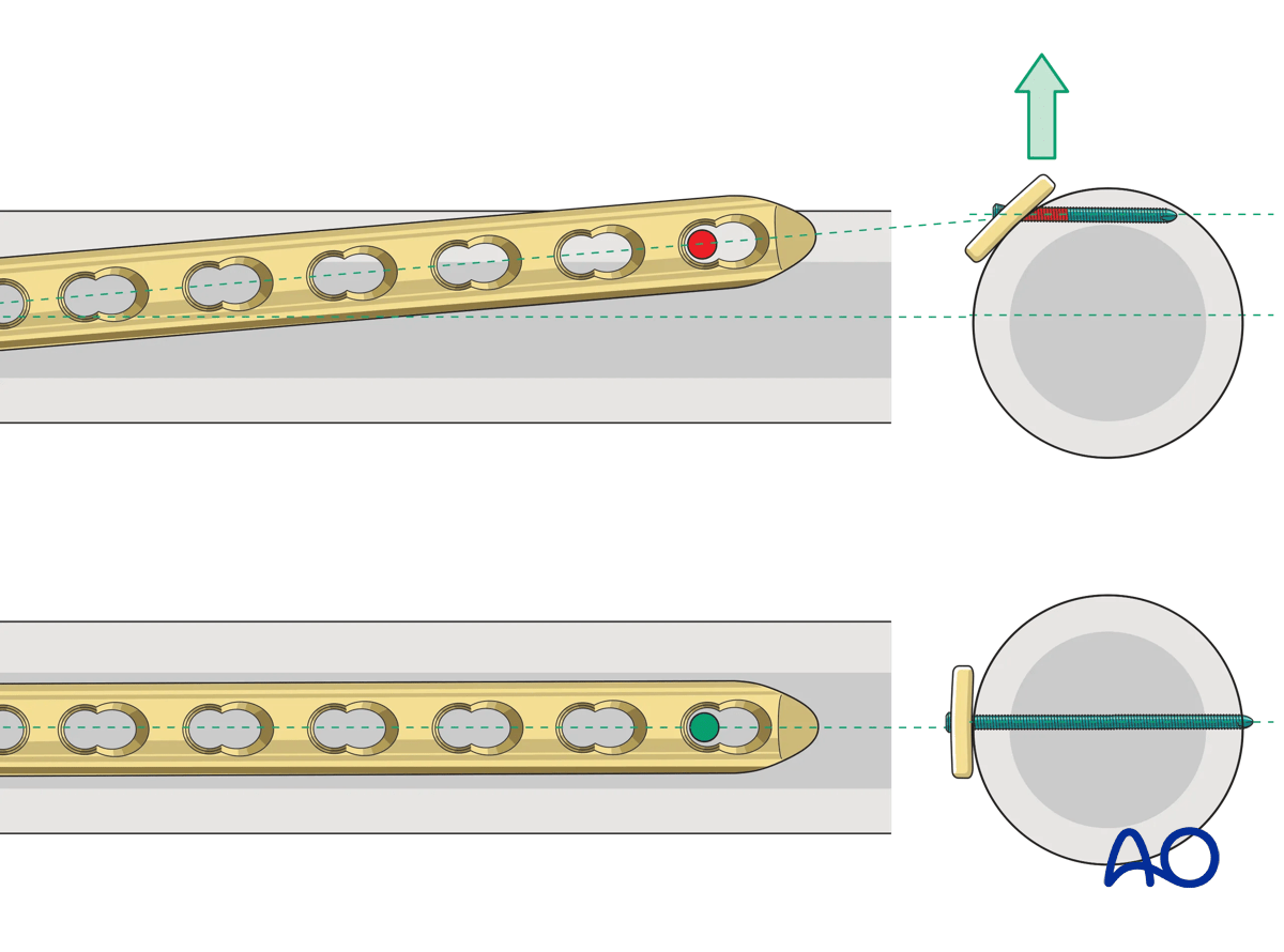 Proximal tibia: plate location