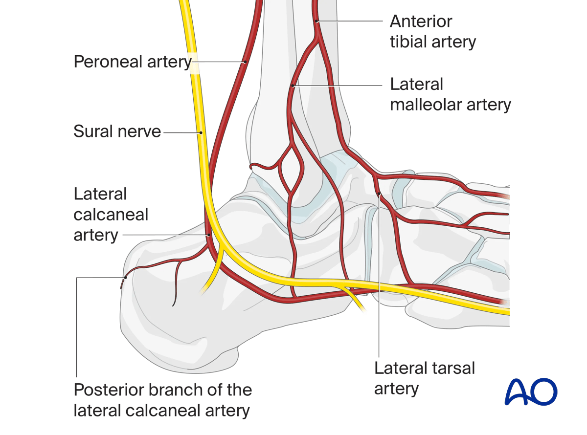 Extended lateral approach to the calcaneus: lateral hindfoot vascular supply; avoid sural nerve to protect artery