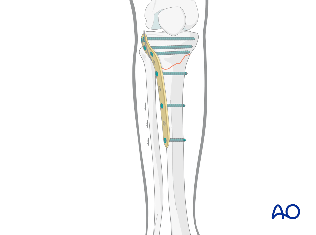 Proximal tibia: Simple extraarticular fracture of the metaphysis Angular stable plating – positioning of the plate