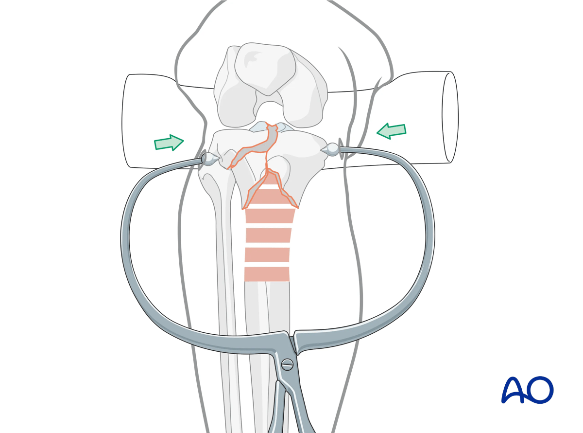 Proximal tibia fracture – ring fixation: fracture fixation