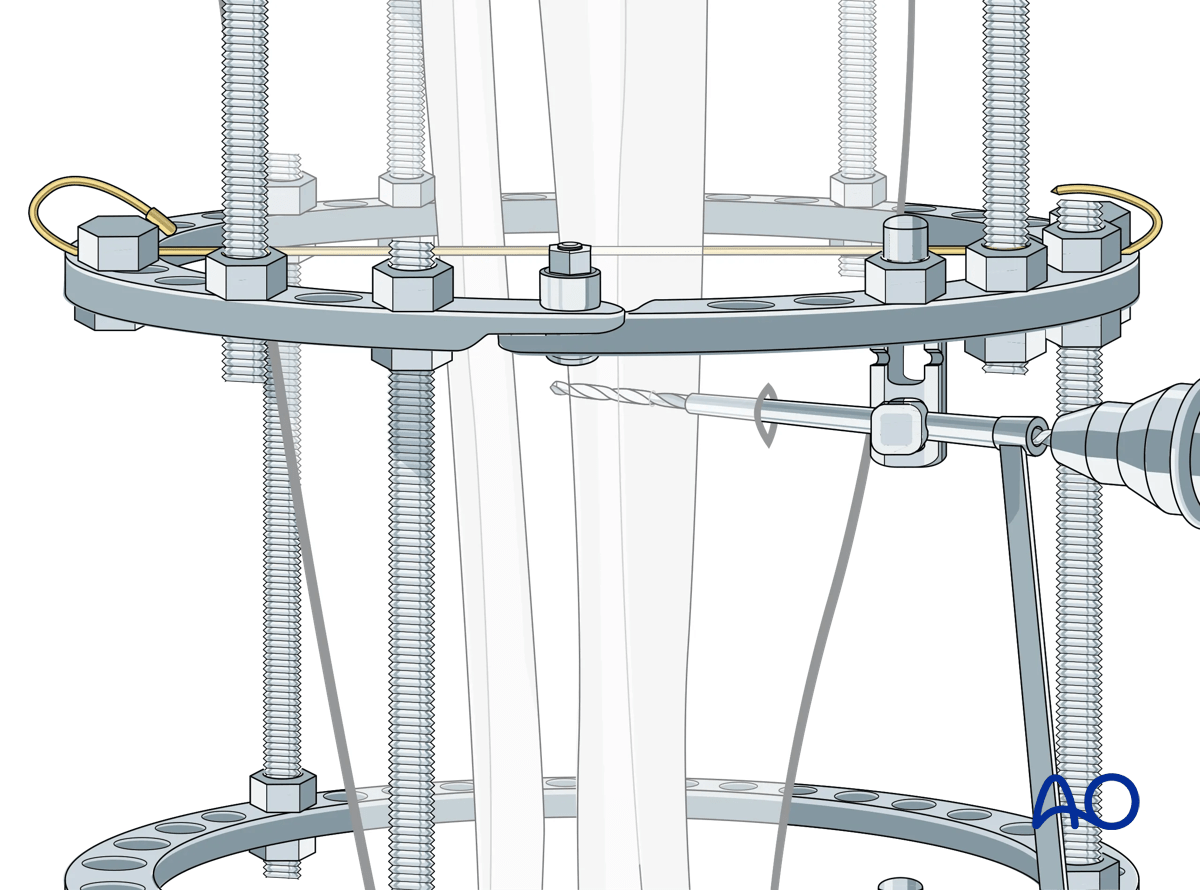 Proximal tibia fracture – ring fixation: Schanz screw placement