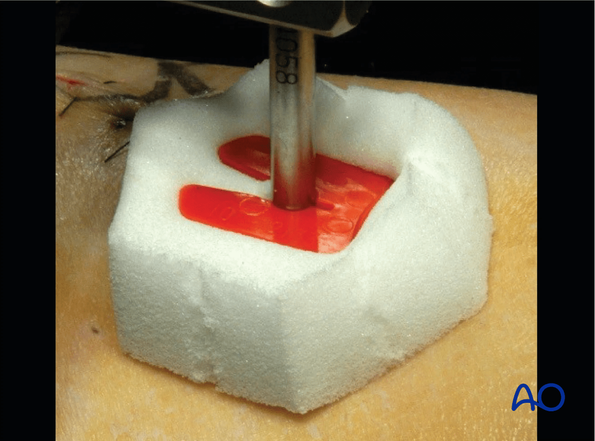 Proximal tibia: Pin site care