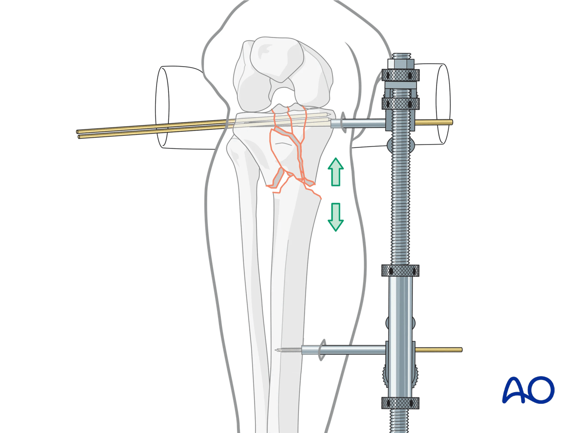 Proximal tibia: complete articular fracture - Angular stable plating – indirect reduction