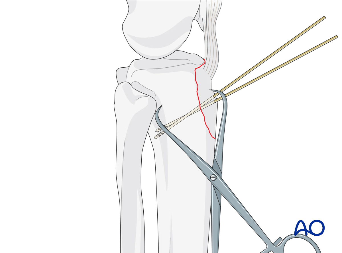 Extraarticular fracture avulsion of tibial tubercle - ORIF - Conventional plating - reduction