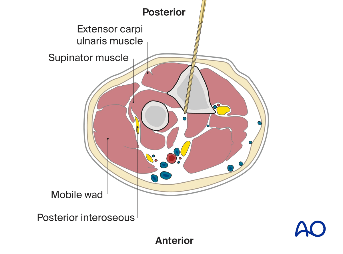 This cross section illustrates a pin inserted into the proximal ulna