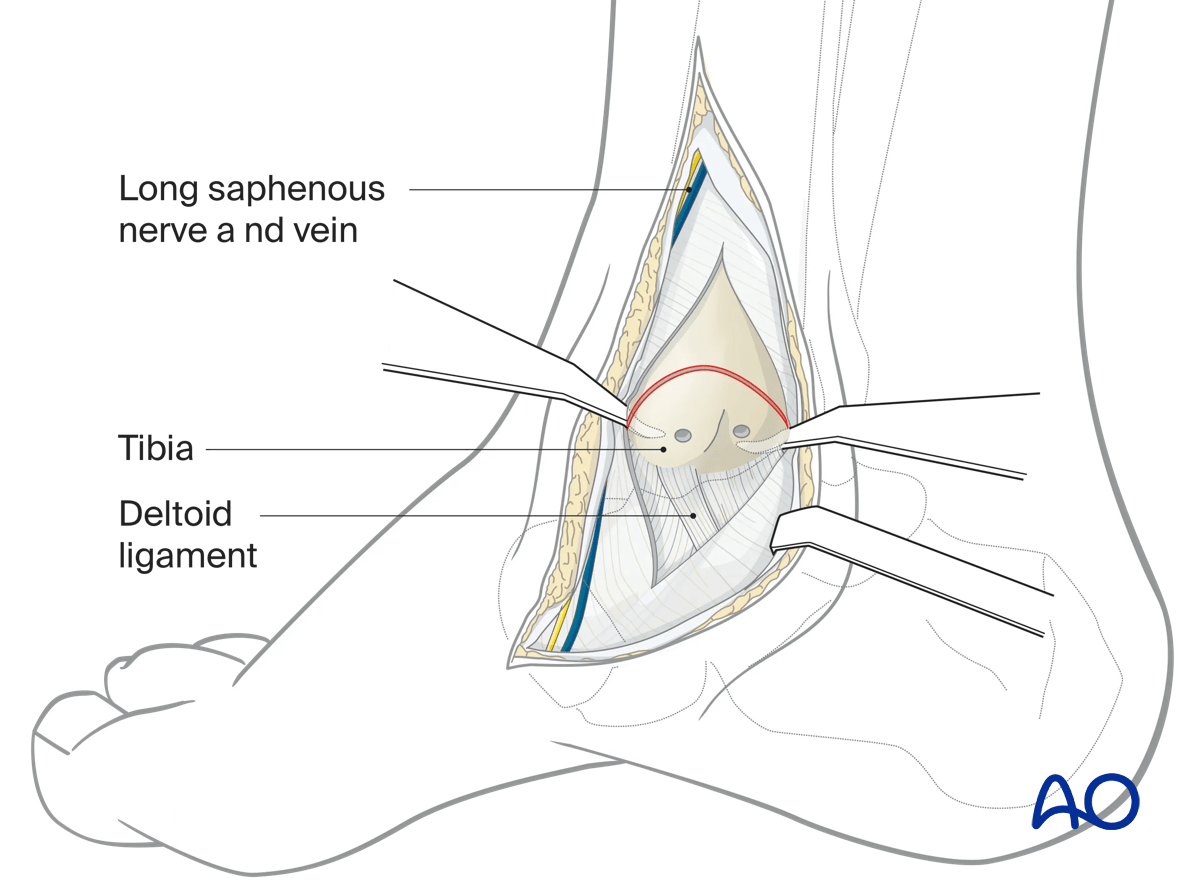 Medial malleolar osteotomy place anterior/posterior flat retractors to protect talar dome and posterior tibialis tendon.