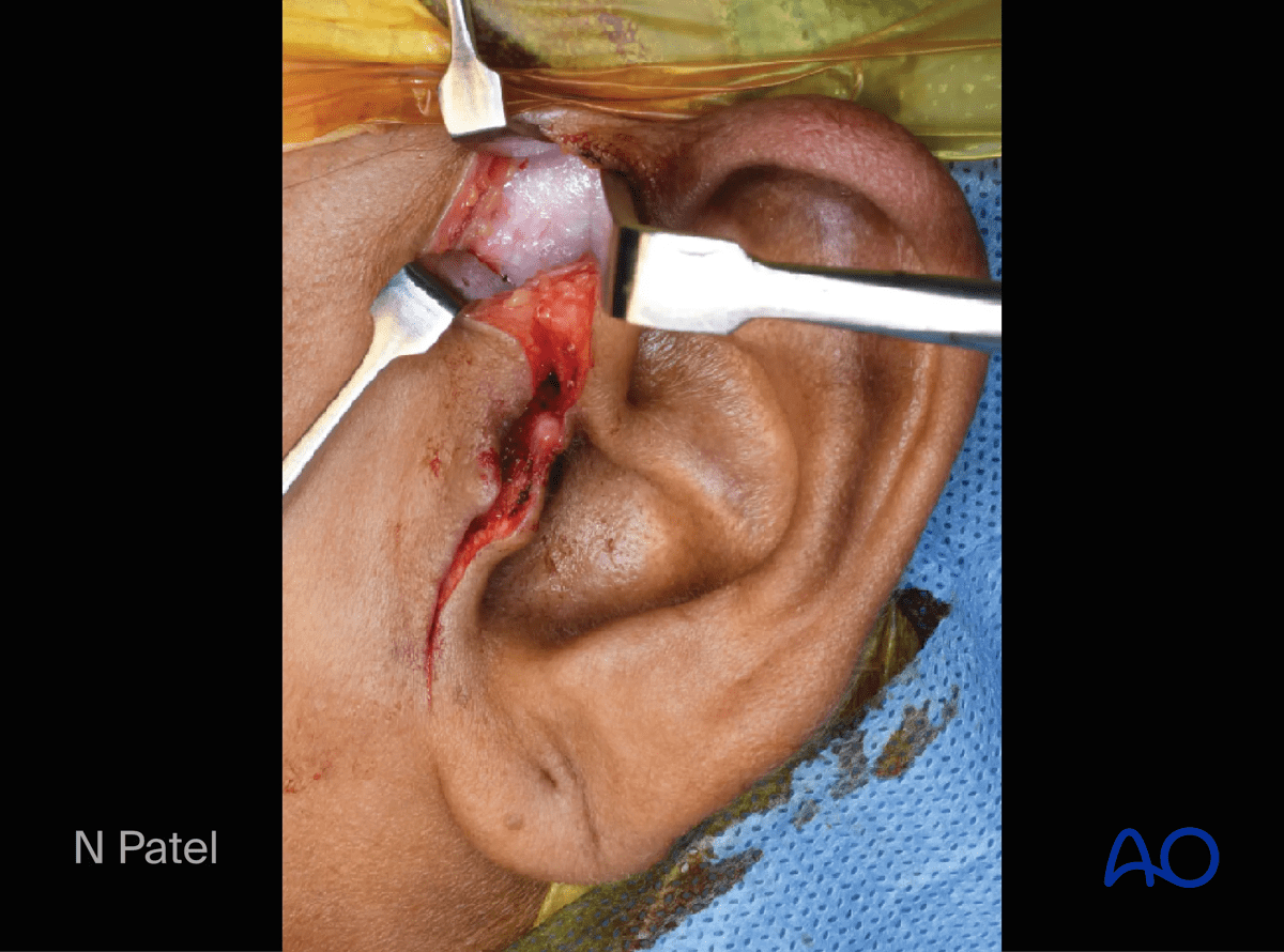 Endaural approach to condyle: Continue the dissection at the cranial end to expose the deep temporal fascia