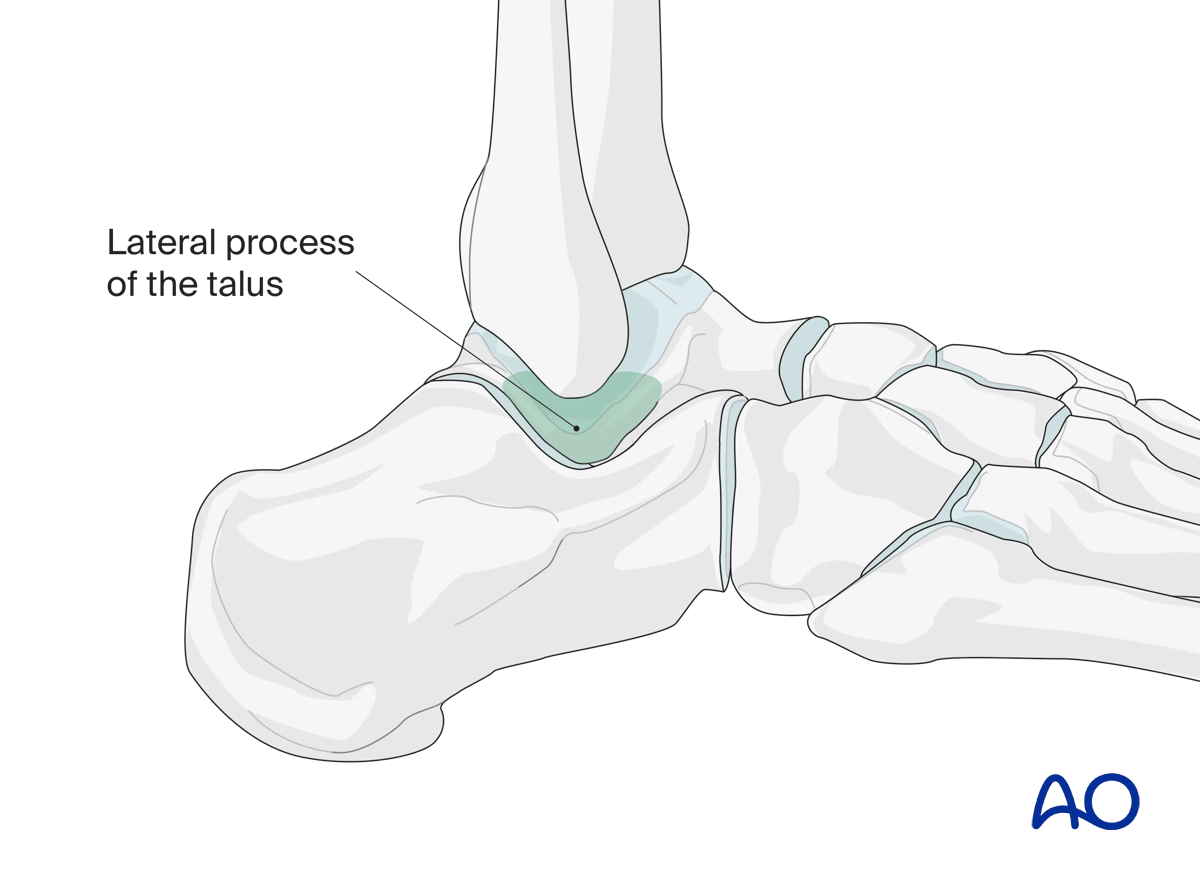 Green window shows direct lateral talus approach for lateral process (“snowboarder’s”) fracture